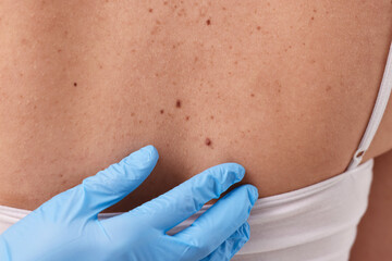 Dermatologist in rubber glove examining patient's birthmark, closeup view