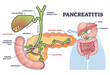 Pancreatitis as pancreas inflammation from chronic or acute gallstones outline diagram. Labeled educational medical scheme with duct anatomy and inflamed digestive tract tissue vector illustration.