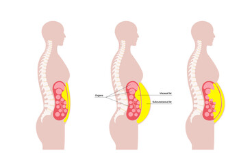 Wall Mural - Visceral fat diagram