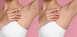 © New Africa - Before and after epilation. Collage with photos of woman showing armpit on pink background, closeup