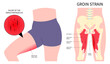 © Pepermpron - thigh pain injury Bursitis fracture in plexus flexion muscle with groin strain or hip lumbar rotation back and Obturator nerve externus lower the first aid of RICE Rest Ice stress torn