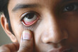 close up showing everted lower eyelid showing lower palpebral conjunctiva for looking pallor in anemia