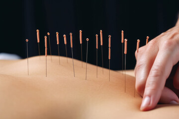 Acupuncture treatment - thin needles on person back skin, closeup detail. Generative AI