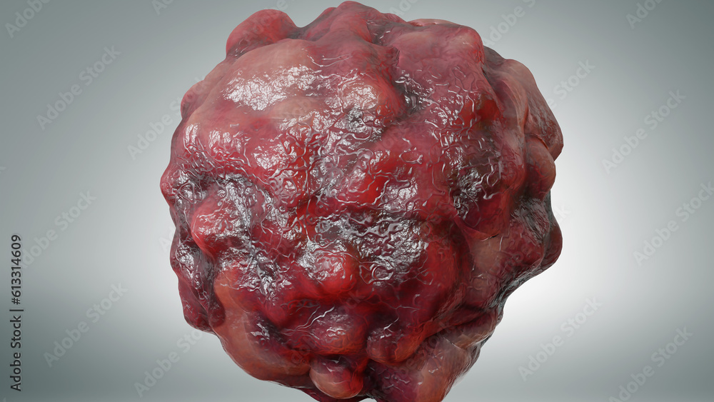 Cancer cell growth uncontrollably over tissue, Tumor infection cells ...