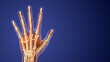 © jitendra jadhav - Rheumatoid arthritis of hand medical background