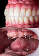 © Garo - Emax ceramics on hybrid implant bridge