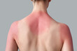 © Pixel-Shot - Allergic young woman with sunburned skin on grey background, back view