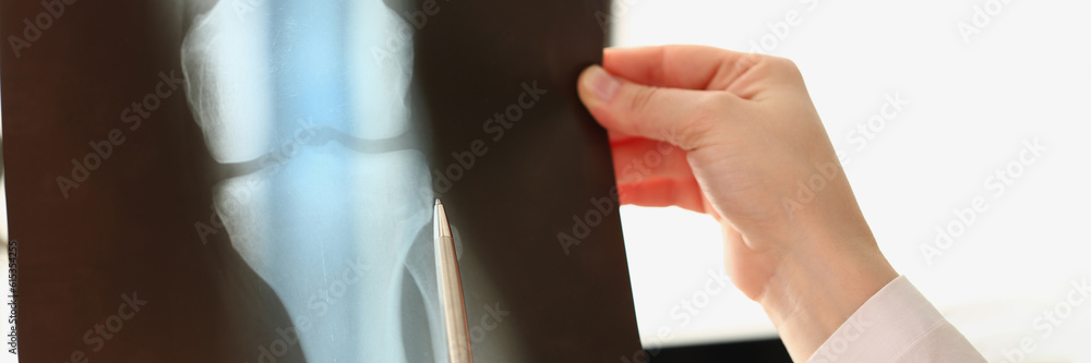 Female doctor looks at x-ray of knee injury in hospital. Sequelae of ...