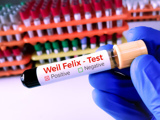 Canvas Print - Blood sample for Weil Felix test, to diagnose rickettsia infections.