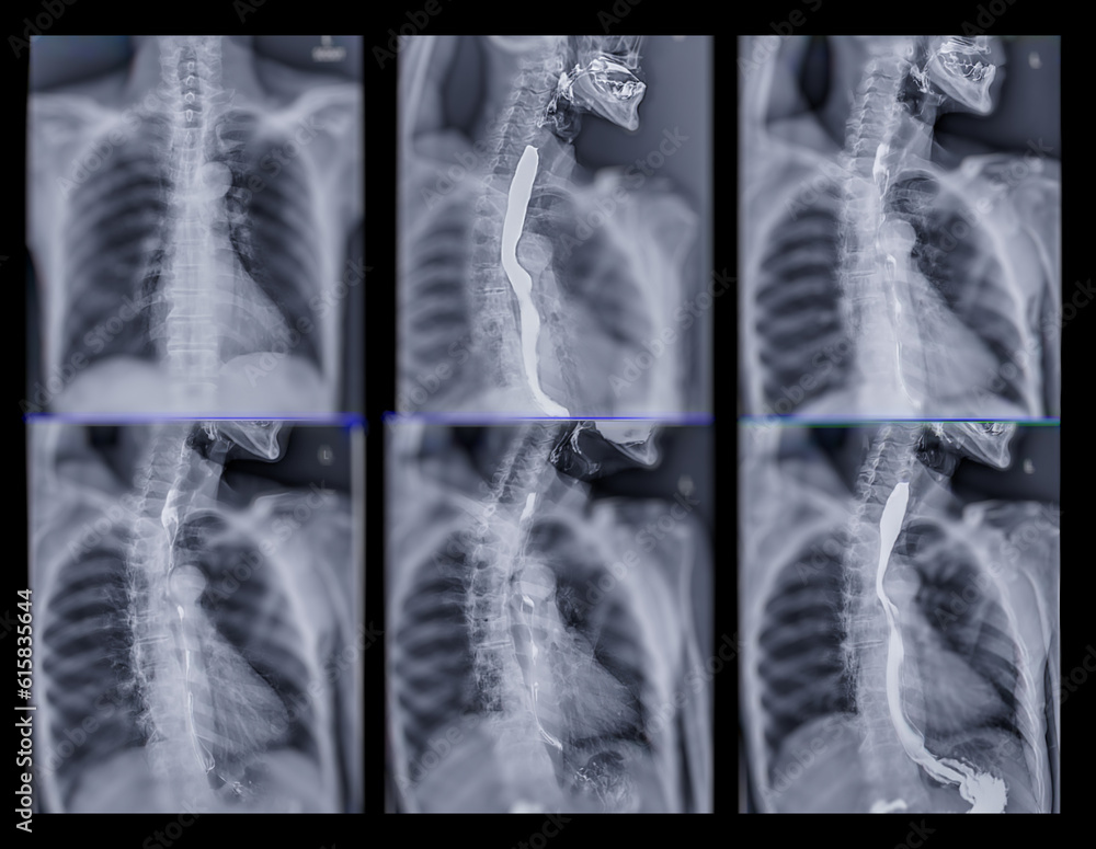 Barium Swallow study test diagnose Barrett's GI tract exam GERD ulcers ...