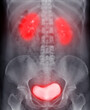  Intravenous pyelogram or I.V.P is an X-ray exam of urinary tract after injection contrast media agent  .
