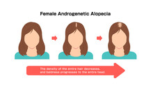 Progress Of Female Androgenetic Alopecia. Vector Illustration