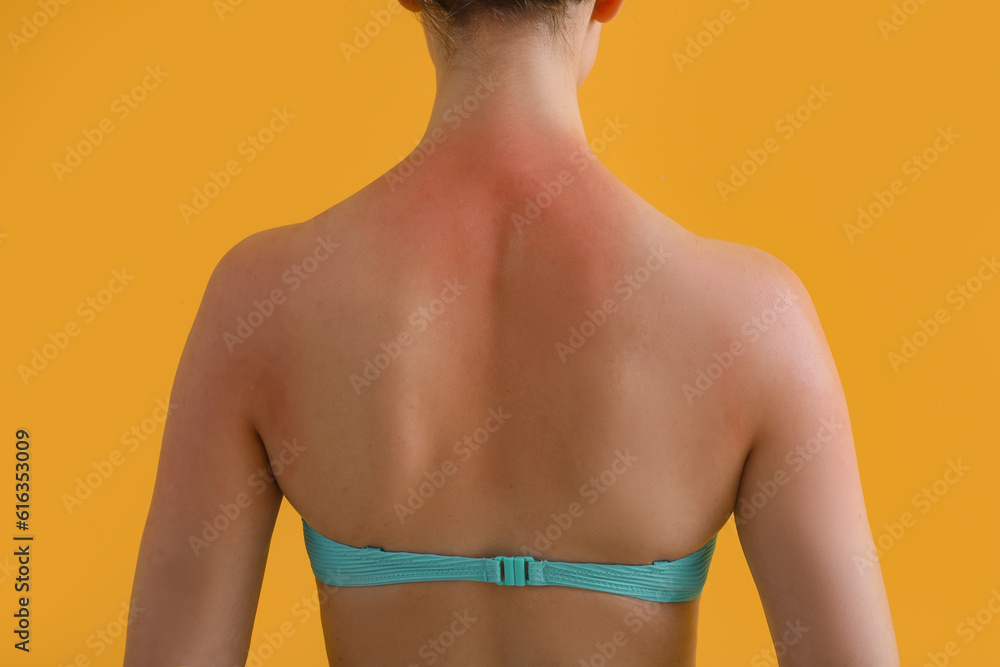 Allergic young woman with sunburned skin on yellow background, back view