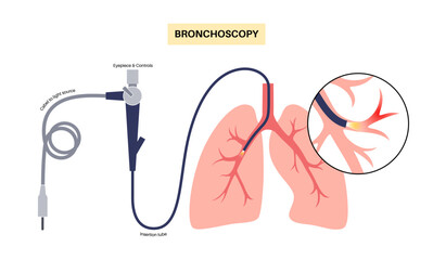 Canvas Print - Bronchoscopy procedure concept