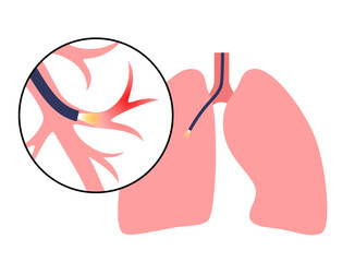 Canvas Print - Bronchoscopy procedure concept