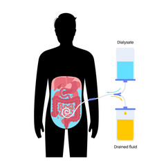 Canvas Print - Peritoneal dialysis concept