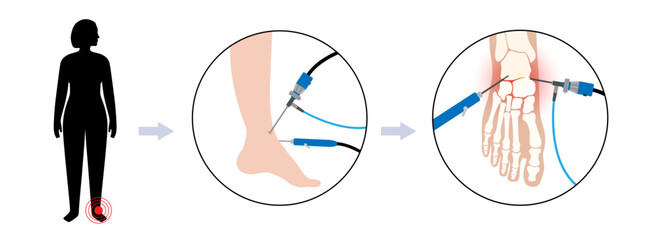 Poster - Ankle arthroscopy poster