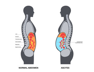 Canvas Print - Ascites disease poster