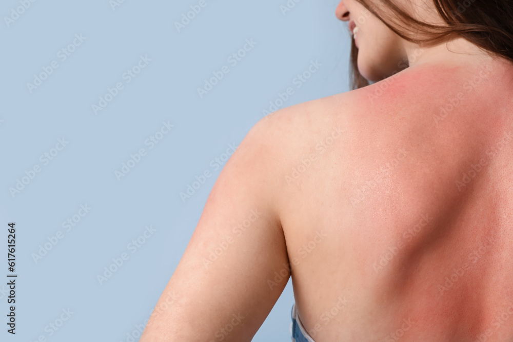 Allergic young woman with sunburned skin on blue background, back view