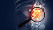 © Crystal light - Magnifying glass showing the spine cancer or spinal tumor disease. 3d illustration