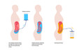 Peritoneal dialysis concept