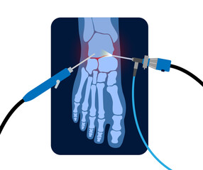 Poster - Ankle arthroscopy poster