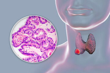 Sticker - A 3D scientific illustration showcasing a human body with transparent skin, revealing a tumor in his thyroid gland, along with a micrograph image of thyroid cancer.