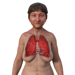 Sticker - A 3D illustration of the upper half part of a female patient with transparent skin, revealing the condition of smoker's lungs