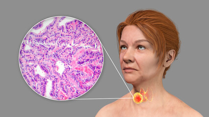 Wall Mural - A 3D scientific illustration showcasing a woman with transparent skin, revealing a tumor in her thyroid gland, along with a micrograph image of thyroid cancer.