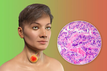 Sticker - A 3D scientific illustration showcasing a woman with transparent skin, revealing a tumor in her thyroid gland, along with a micrograph image of thyroid cancer.