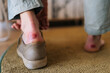 © dikushin - Closeup of unrecognizable man sitting on bench, takes off shoe and shows big callus on foot. Male suffering from pain due to callus on heel of foot. Painful wound on mans feet caused by new shoes.