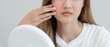 Young woman are worried about faces Dermatology and allergic to steroids in cosmetics. sensitive skin, red face from sunburn, acne, allergic to chemicals, rash on face. skin problems and beauty