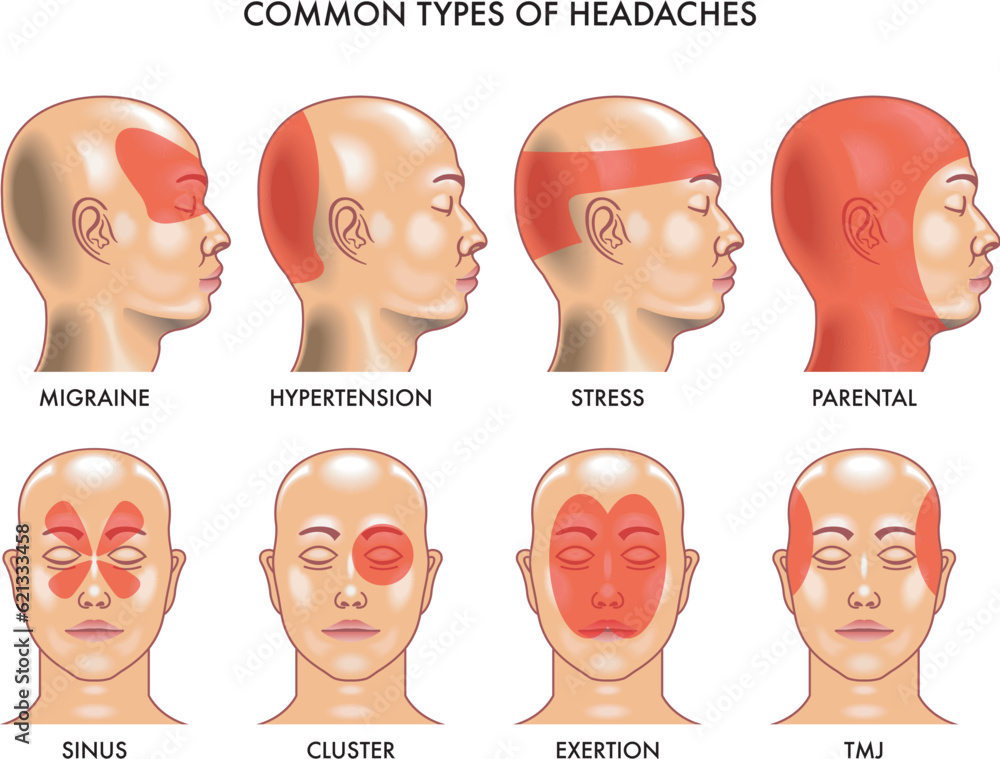 Medical Illustration of common types of headaches.