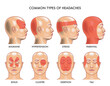 Medical Illustration of common types of headaches.