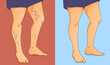 Human body with health problems. Varicose veins. Before, after. Vector illustration. Healthcare illustration. 