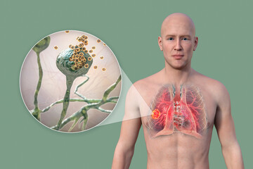 Canvas Print - A 3D illustration of the upper half part of a man with transparent skin, revealing a lung mucormycosis lesion, with close-up view of Rhizopus fungi