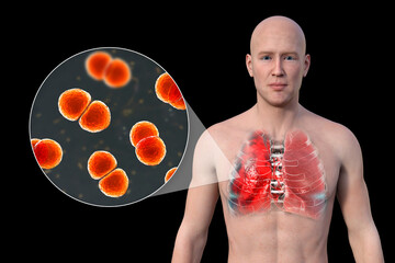 Canvas Print - A 3D illustration showcasing the upper half part of a man with transparent skin, revealing the lungs affected by pneumonia