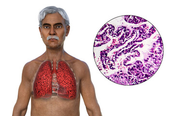 Sticker - A 3D illustration of the upper half part of a man with transparent skin, revealing the condition of smoker's lungs