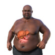 A 3D illustration featuring an overweight man with transparent skin, showcasing the liver and highlighting the presence of liver steatosis.