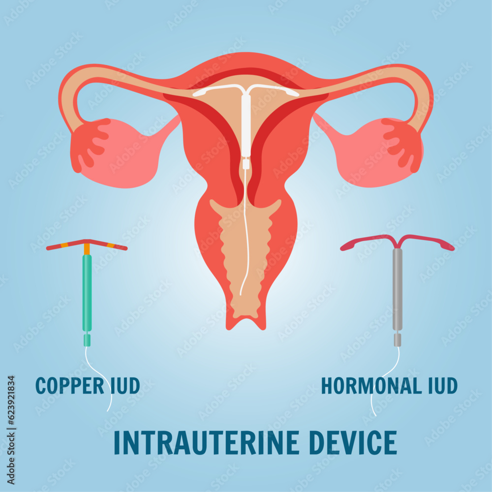 Reproductive Contraception Method of IUD contraception control and protection of pregnancy ...