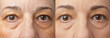 Xanthelasma on all 4 eyelids of a 55 years old woman, before and after applying camouflage make-up on lower and eye shadow on the spots of upper lids.
