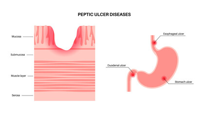 Canvas Print - Peptic ulcer disease