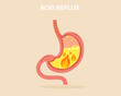 Suffering from GERD symptom with acid reflux stomach heartburn with burning acid inside digestive system gastritis problem.
