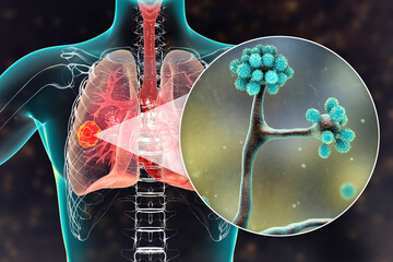 Canvas Print - Lung mucormycosis lesion caused by Cunninghamella bertholletiae fungi, 3D illustration