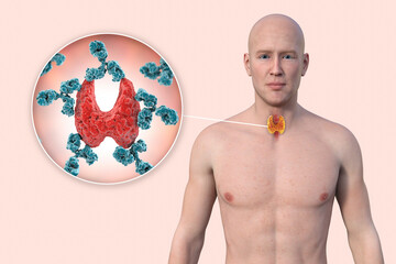 Sticker - Autoimmune thyroiditis, conceptual illustration