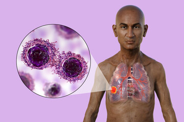 Sticker - A 3D illustration of a man with transparent skin, revealing the presence of lung cancer