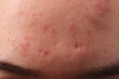 © New Africa - Young man with acne problem, closeup view of forehead
