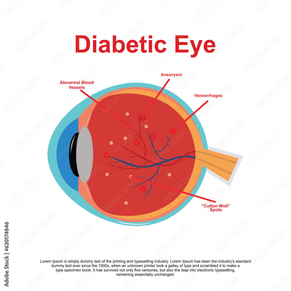 Diabetic retinopathy vector illustration diagram anatomical scheme