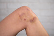 Close-up of bruises on the skin of an injured woman's legs