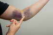 Applying ointment to a fingertip to massage a bruise on an arm.